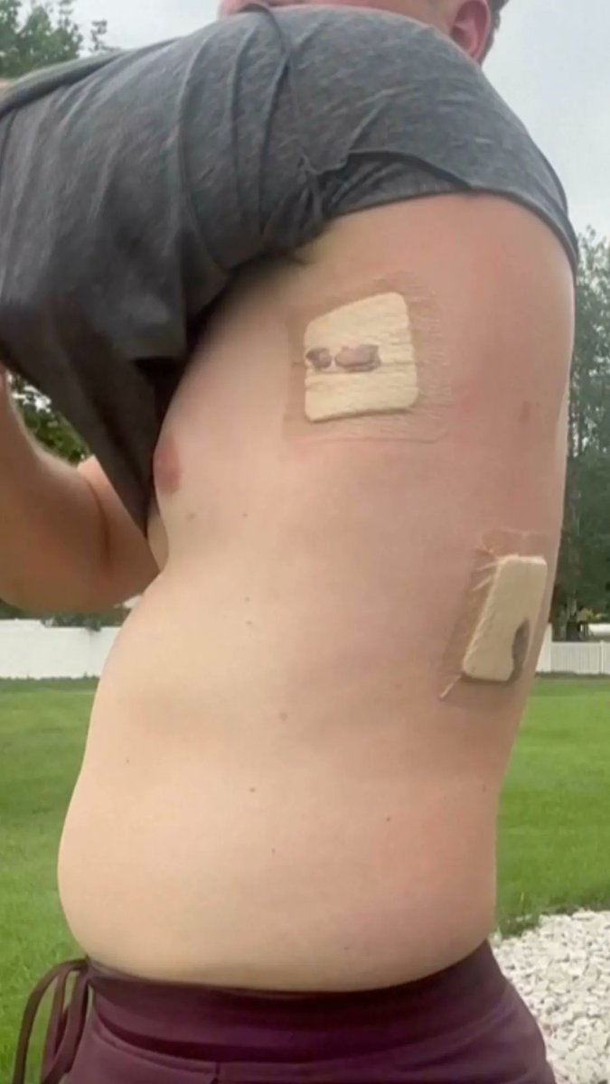 Un randonneur qui s'est accidentellement empalé sur un bâton de randonnée alors qu'il gravissait le plus…