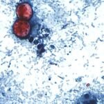 Maladie causée par le parasite Cyclospora désormais dans 45 États : CDC
