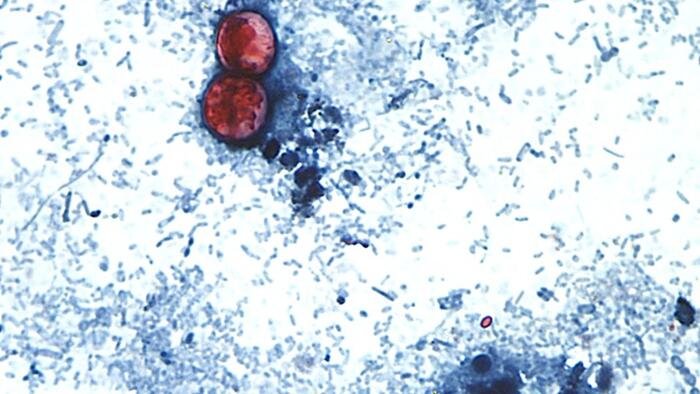 Maladie causée par le parasite Cyclospora désormais dans 45 États : CDC